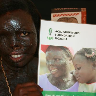 Uganda Acid Survivors 016