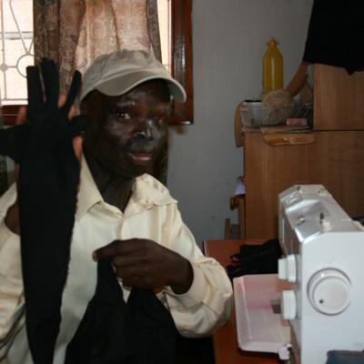 Uganda Acid Survivors 020