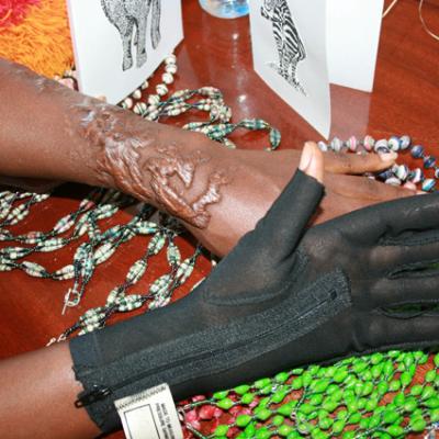 Uganda Acid Survivors 022