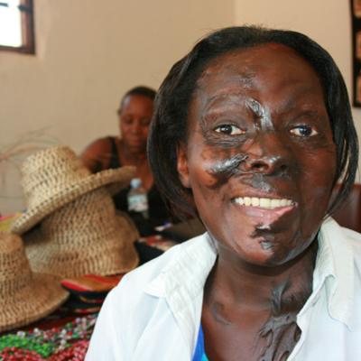 Uganda Acid Survivors 025