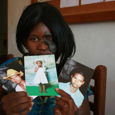 Uganda Acid Survivors 028