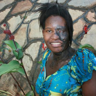 Uganda Acid Survivors 030