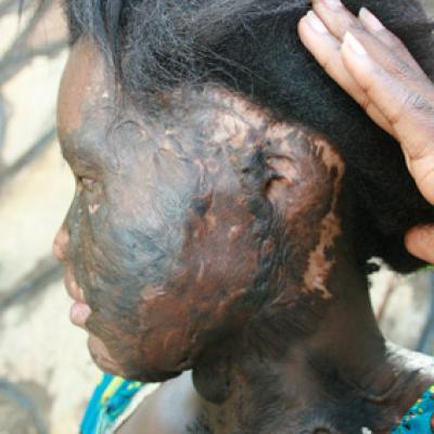 Uganda Acid Survivors 034