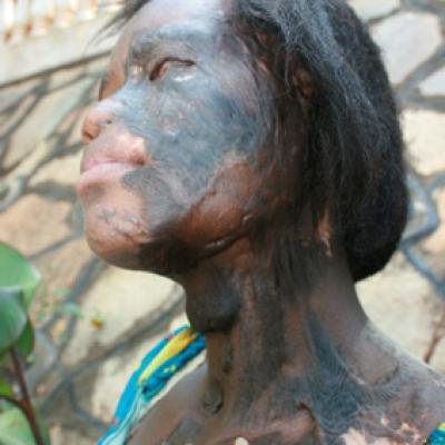 Uganda Acid Survivors 035