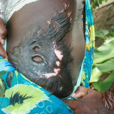 Uganda Acid Survivors 038
