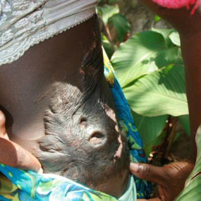 Uganda Acid Survivors 039