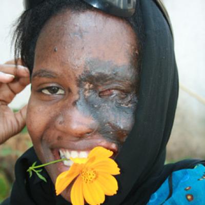 Uganda Acid Survivors 040